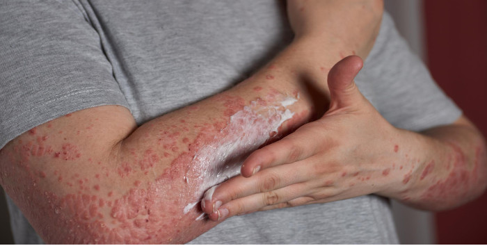 Psoriasis cuir chevelu, psoriasis visage…quels traitements ?